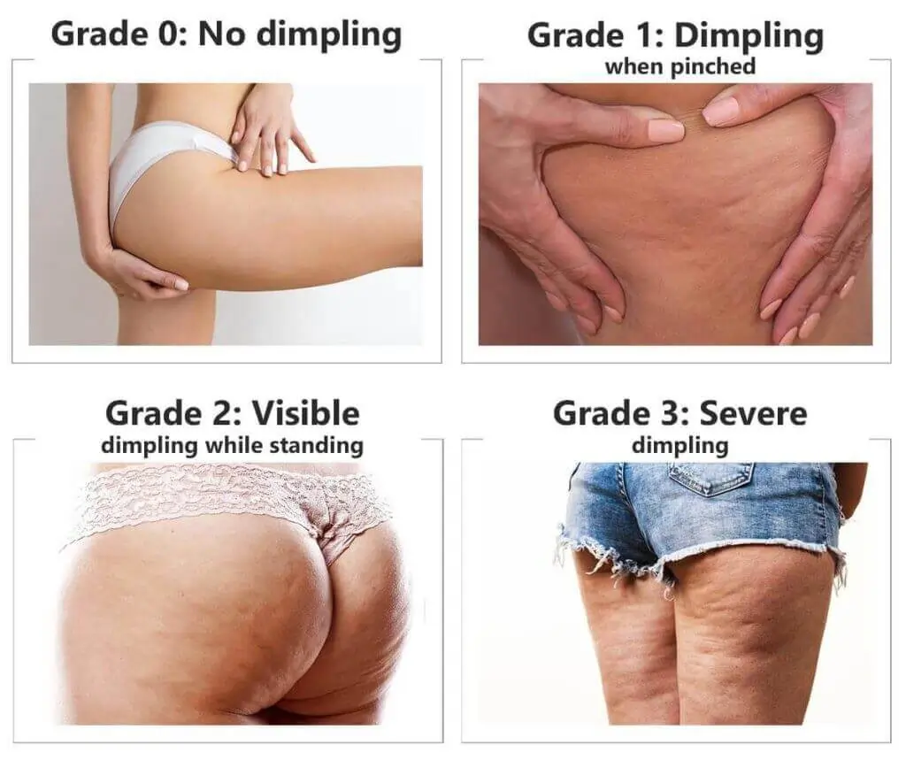 Representation of the stages of cellulite development Weymouth